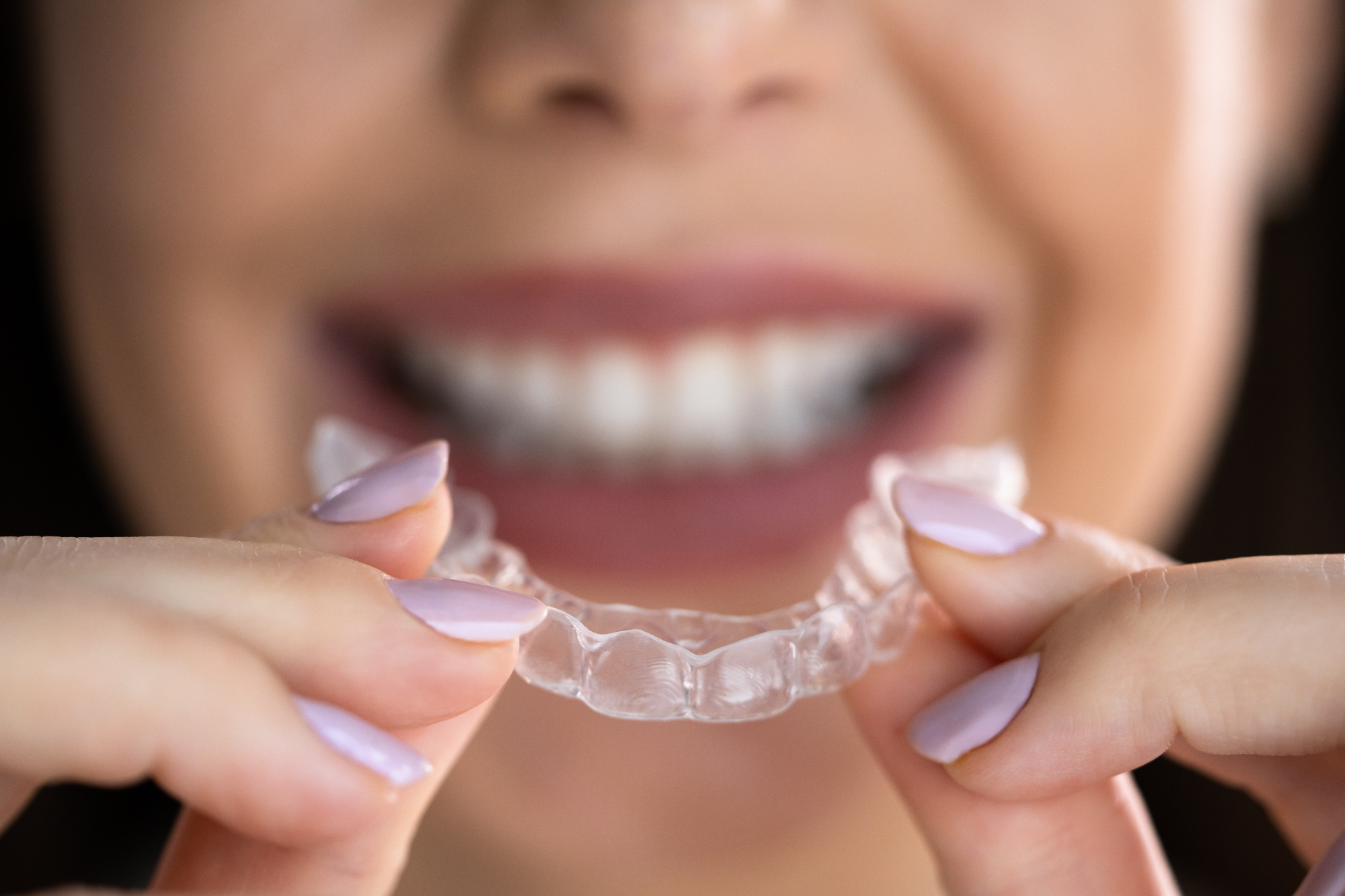 Ortodont mi je priporočil Invisalign